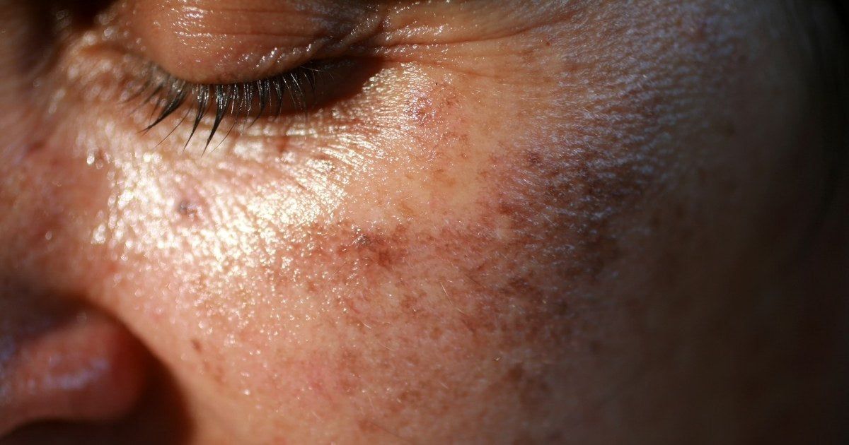 Melasma: Más Allá de la Superficie de la Piel