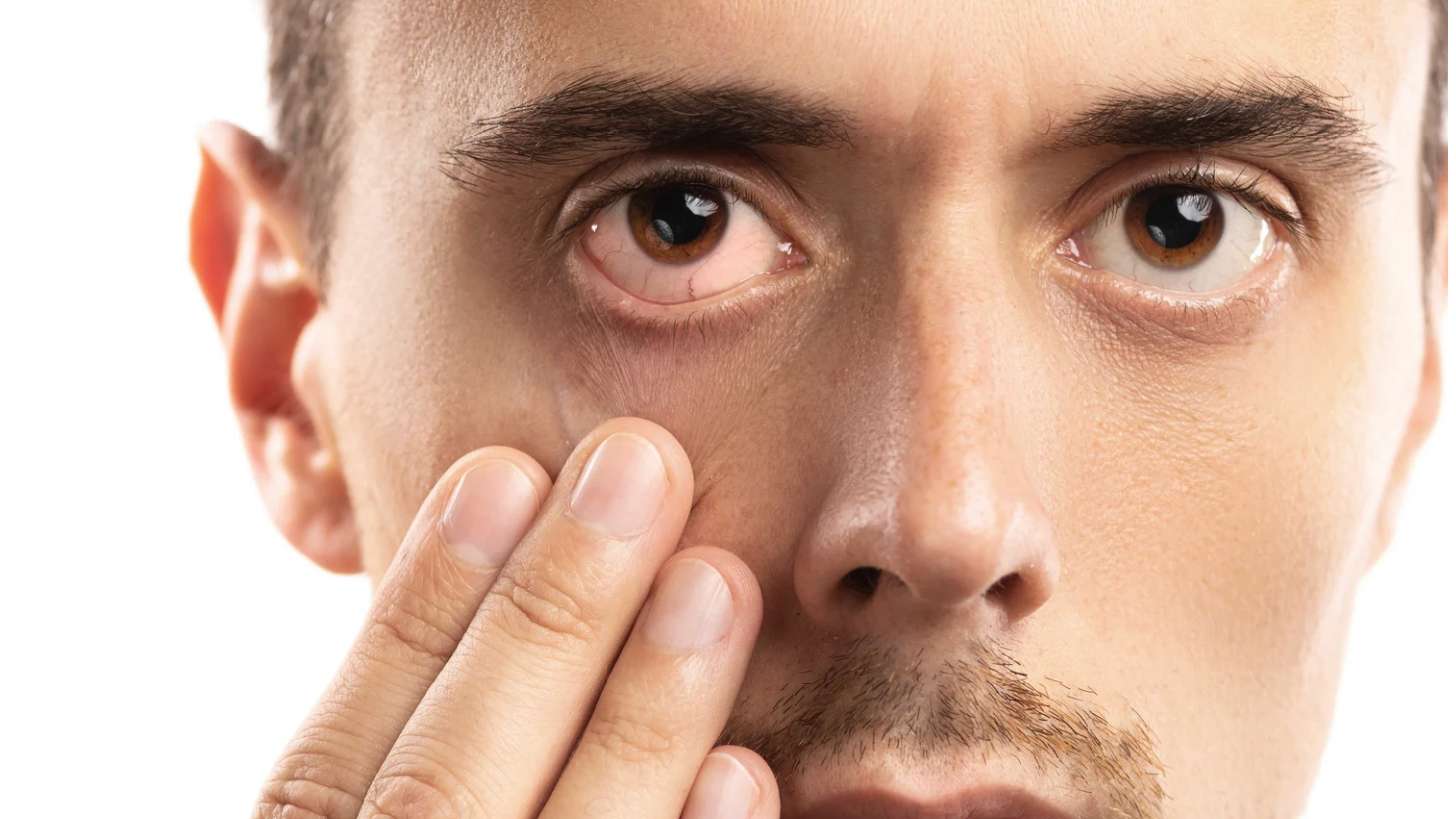 COMPRENDIENDO Y TRATANDO LAS OJERAS
