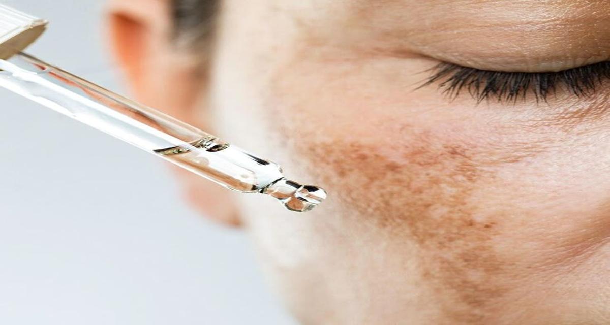 Melasma: Más Allá de la Superficie de la Piel