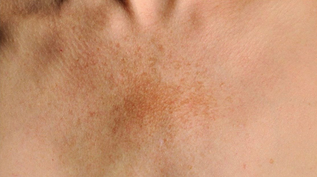 Retinol para el Melasma: Cómo Funciona y Cómo Usarlo Correctamente