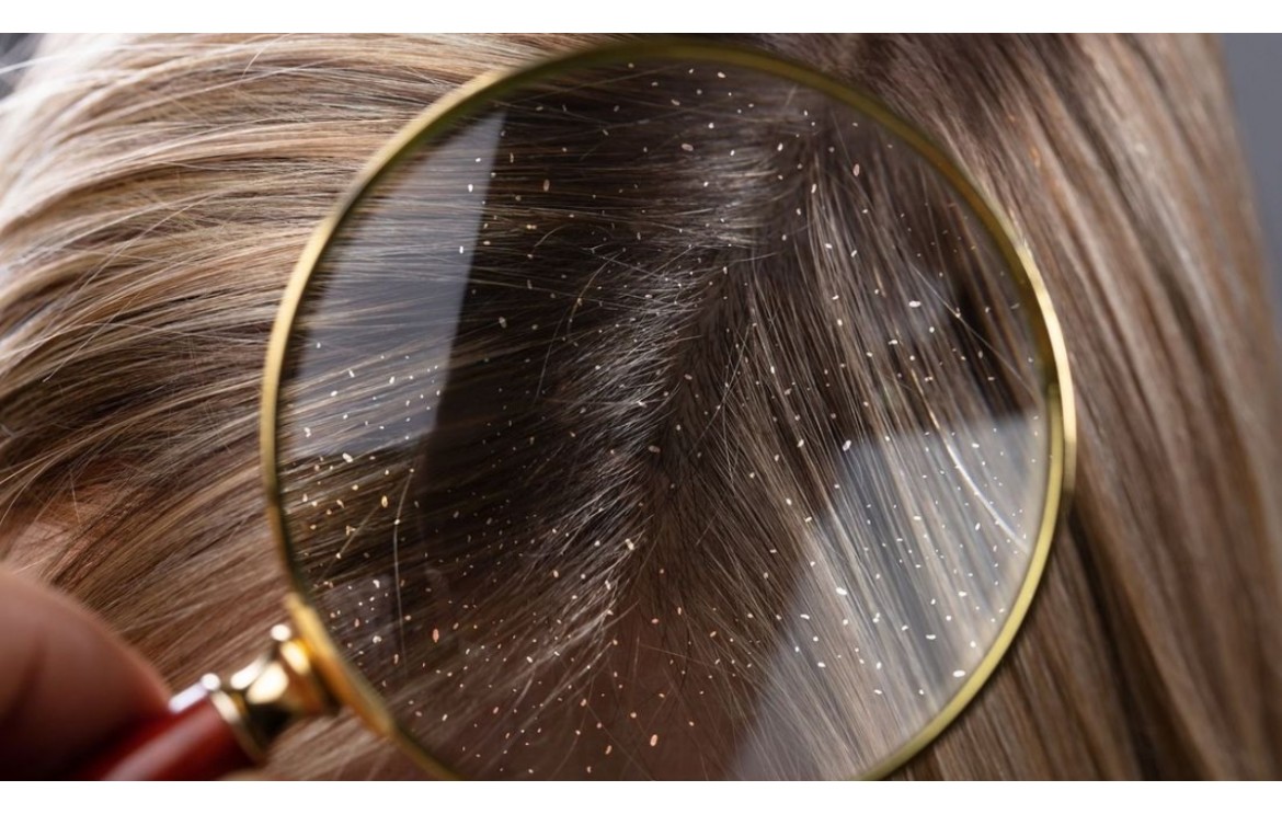 Desbloqueando el secreto para un cabello sin caspa